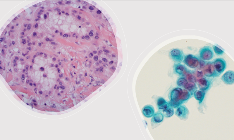 BAC Case Study and Quiz for August - Cytology histology correlation confirms an unusual variant of a common malignancy