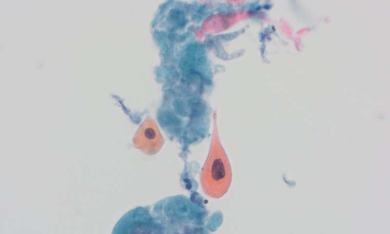 BAC Lunchtime Slide Club: Three Fascinating Mediastinal and Pulmonary Cytology Cases
