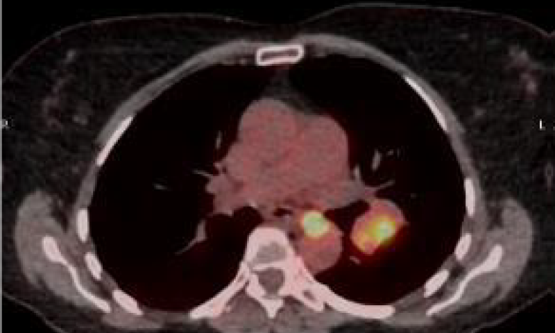 October 2025 - Case Study - Hodgkin Lymphoma in EBUS