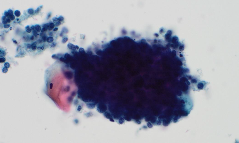 March case study. Cervical cytology - Small crowded hyperchromatic groups