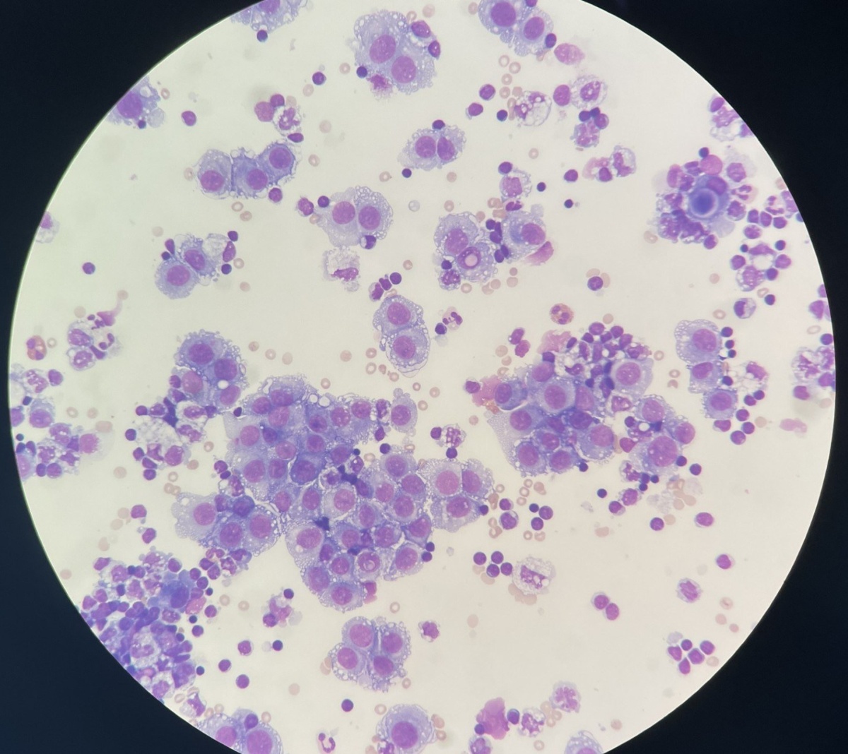 Meso melanoma resized