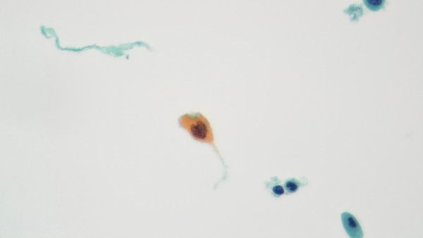 Heart balloon Julie Papadopoulos Manchester Cytology Centre