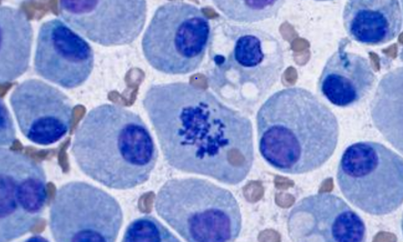 March 2025 Case Study - Pleural fluid and molecular analysis