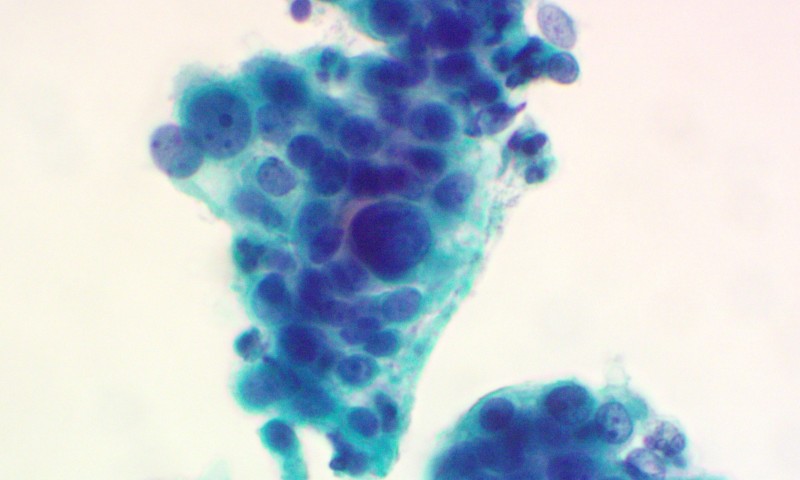 Understanding Borderline Endocervical Reports in UK Cervical Screening - webinar report