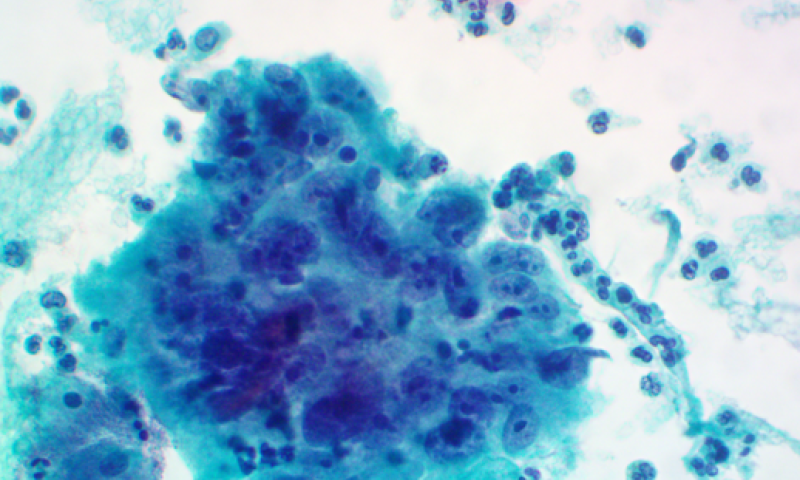 April 2025 Case study - Learning points from cervical cancer audit cases