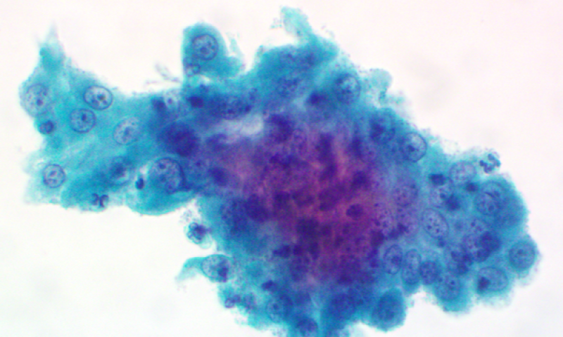 April 2025 Case Study - Learning points from cervical cancer audit cases