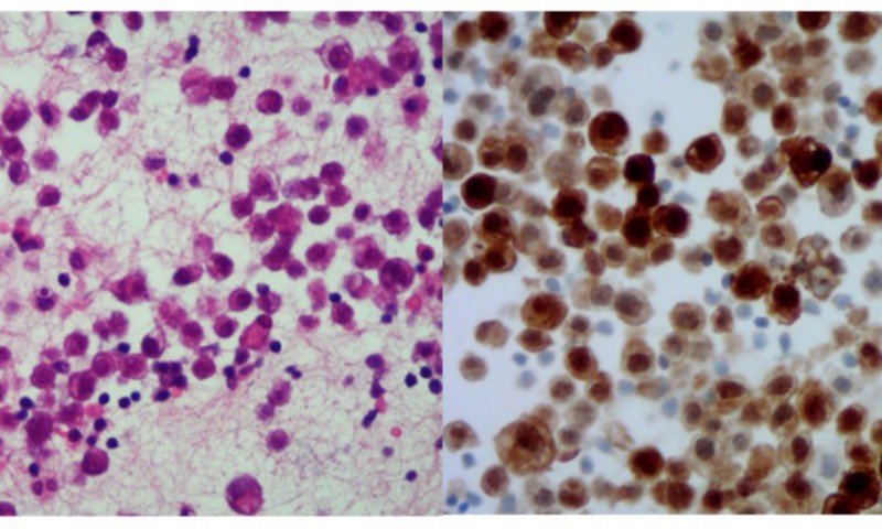 August 2025- Case Study - Calretinin Expression in High Grade Invasive Breast Carcinoma