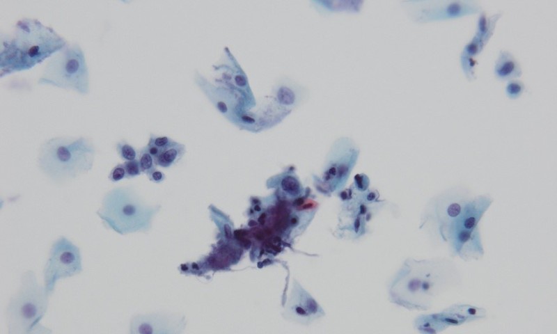 European guidelines on cervical cancer screening and diagnosis