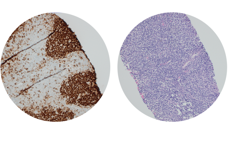 February 2024 Case Study - A potential pitfall in low-grade lymphoma