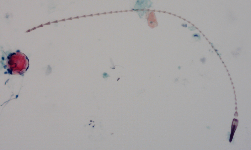 Carpet beetle larval hair in a urine sample