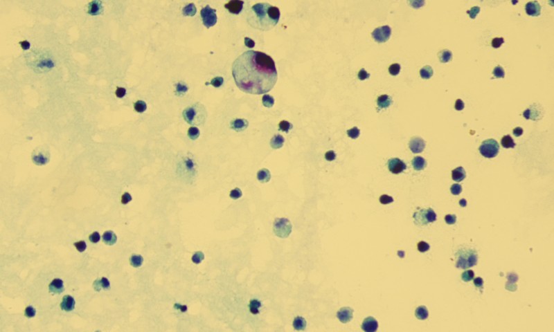 CSF cytology from a 45-year-old patient with a history of gastric adenocarcinoma and carcinomatous meningitis.