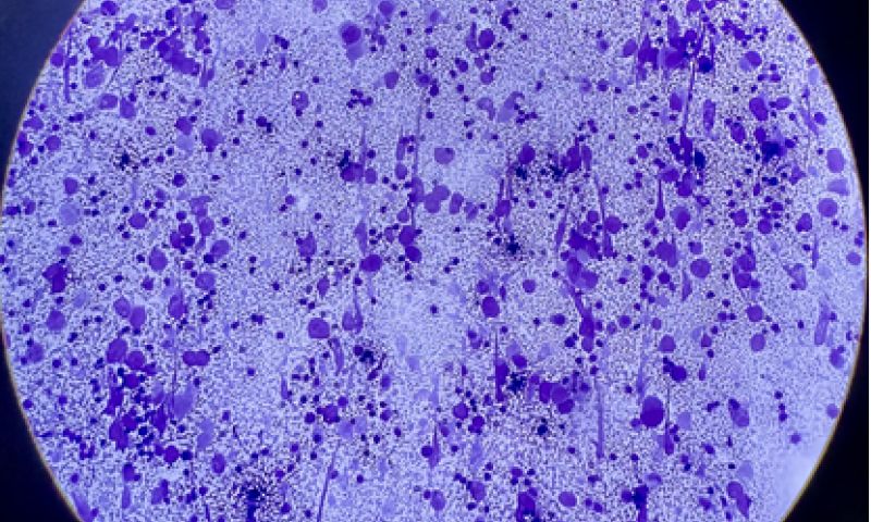 A tiger is known by its stripes. A seminoma, by its tigroid background.