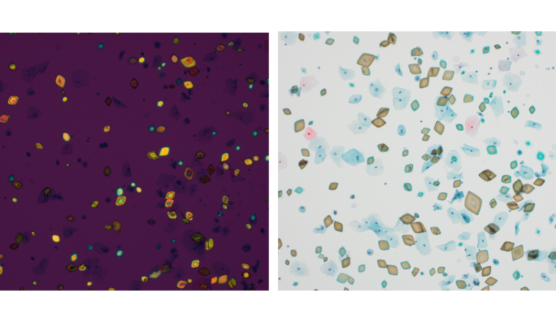 Urate crystals in a urine sample