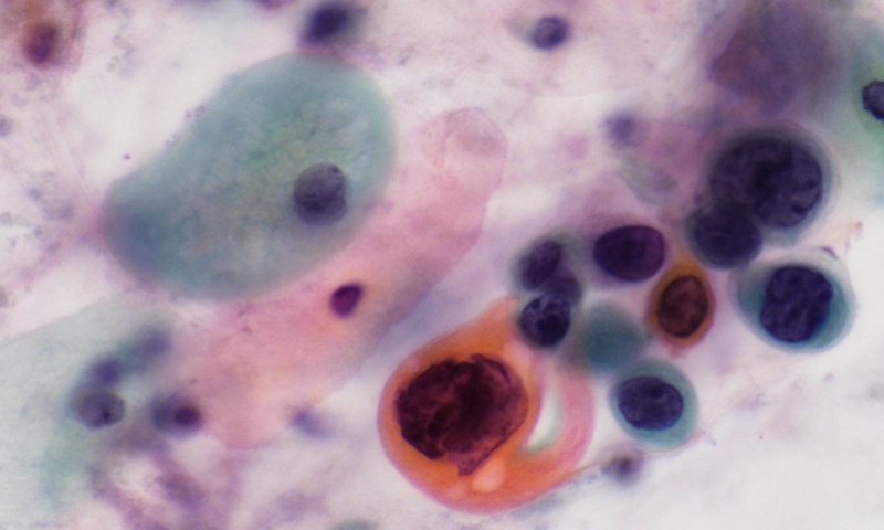 June 2025 - Case Study - Persistent High Grade Dyskaryosis in cytology with Low Grade Histology in a Patient with Vaginal Adenosis and Unusual Cervical Gastric Metaplasia: A Long Term Diagnostic Challenge