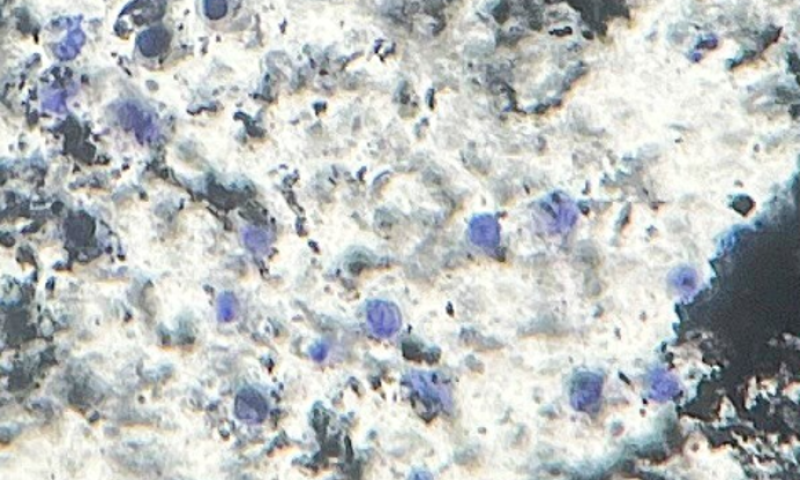 BAC March 2026 Case Study: Synovial fluid – Aspiration of a Joint Following Total Hip Replacement