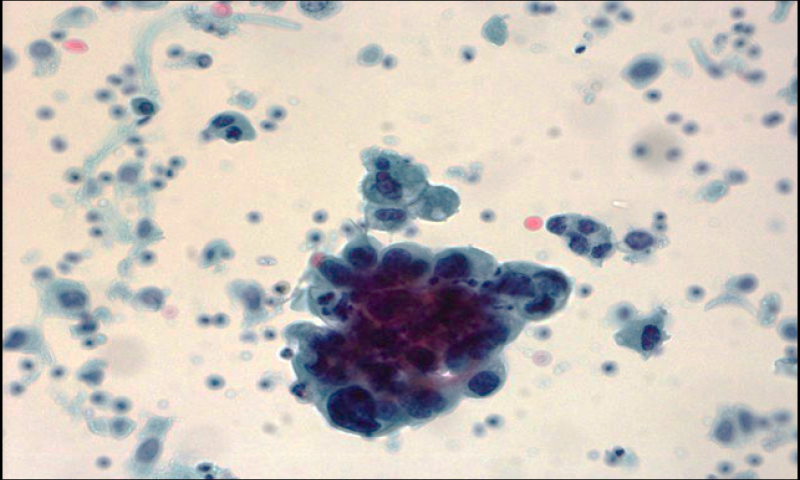 May 2025 - Case Study - Urine Cytology