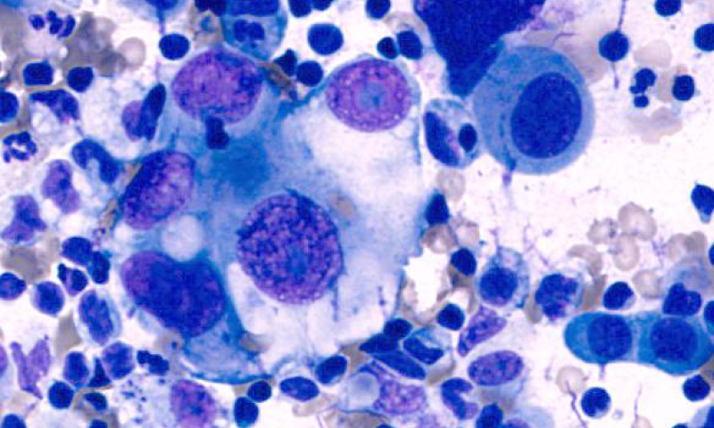 May Case Study - Metastatic adenocarcinoma in ascitic fluid