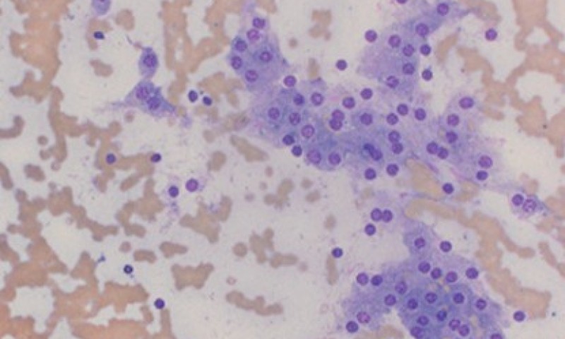 BAC May 2026 Case Study: Benign thyroid cytology