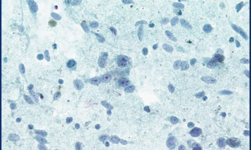 November 2025 Case Study - An FNA of Submandibular Gland