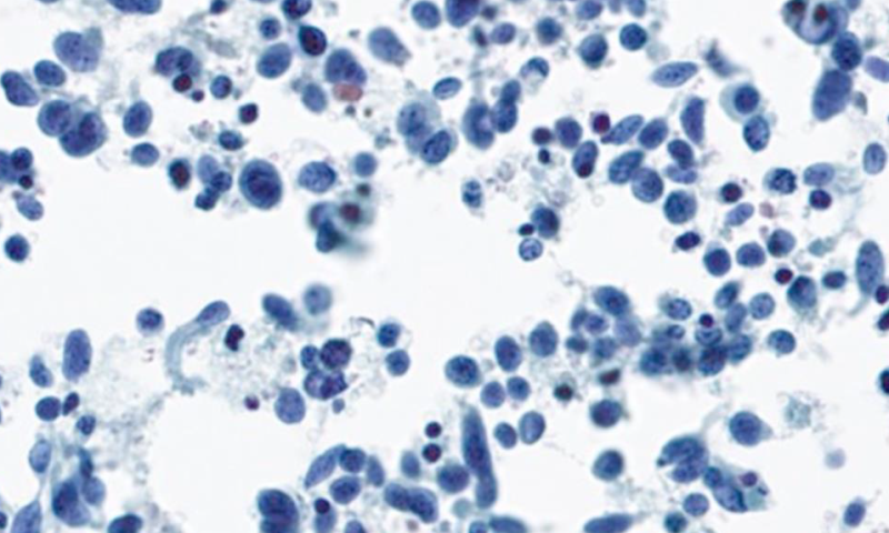 March 2024 Case Study - An unusual diagnosis in FNA Parotid Gland