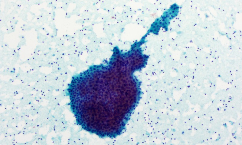 April 2025 Image of the Month - Hank Warthin and the Lymphocytes