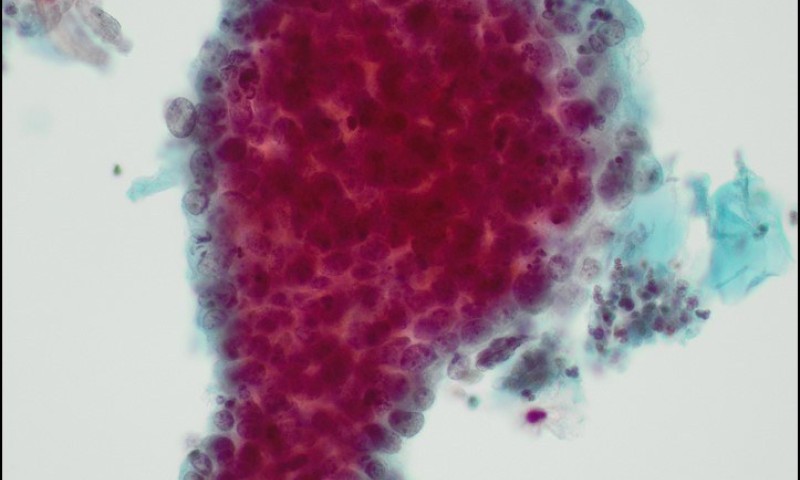 January 2024 Case Study - Cervical Cytology