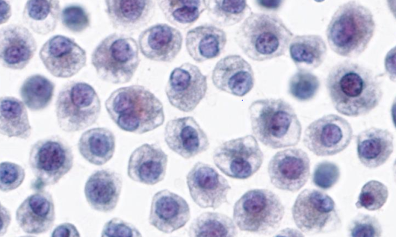 March 2025 Case Study - Pleural fluid and molecular analysis
