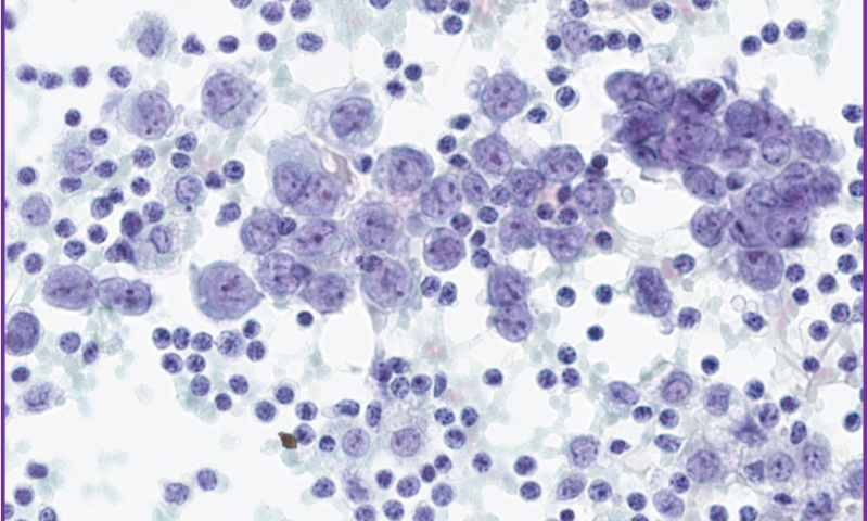 BAC July 2026 Case Study: Sarcoma