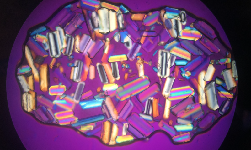 Triple phosphate crystals in urine
