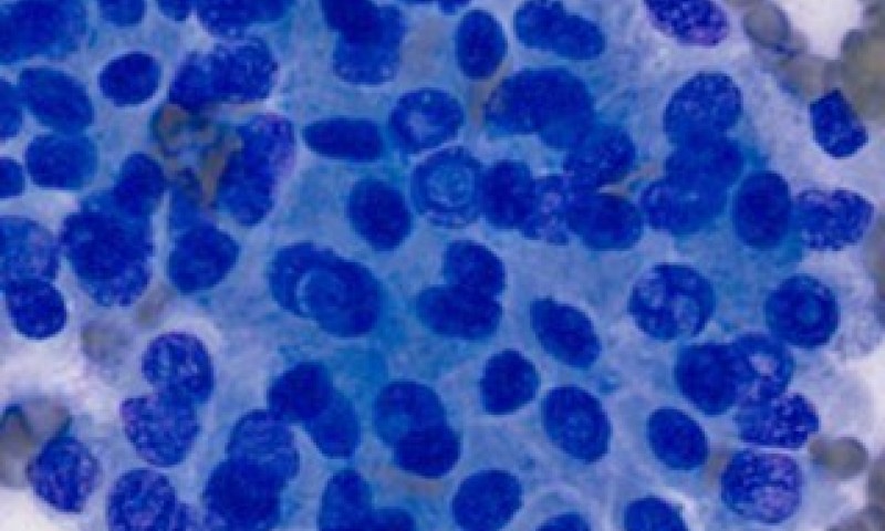 February 2026 Case Study - An FNA of thyroid showing a common malignancy