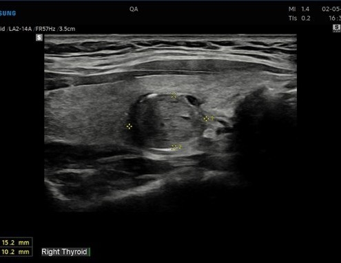 FNA Thyroid July 2026 US cropped