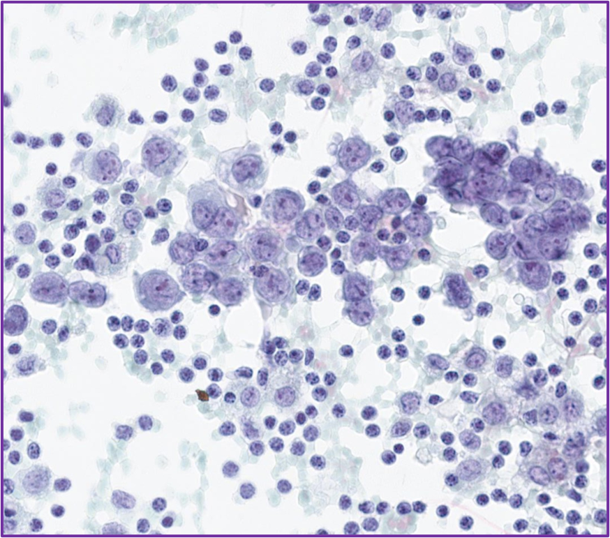 Sarcoma 1
